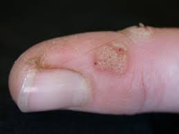 Mole Removal Safe Skin Procedures